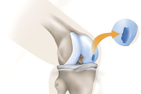traumatic-cartilage-injuries