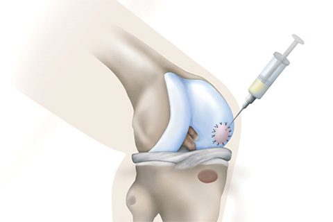 Illustration showing classical autologous cartilage implant procedure