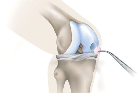 Illustration showing new generation autologous cartilage implant procedure