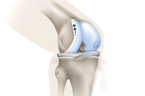 Illustration showing autologous cartilage implant